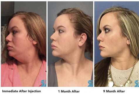The First & Only Injectable Double Chin Treatment .